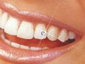 украшения для зубов, имплантанты, драгоценные украшения, стоматолог