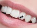 украшения для зубов, имплантанты, драгоценные украшения, стоматолог